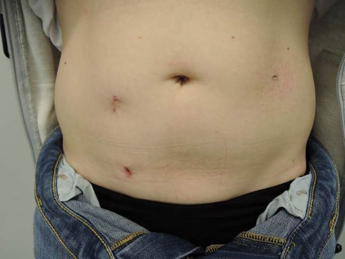 Minimalinvasive Chirurgie